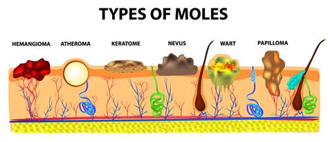 Decoding the Messages: Exploring the Varied Meanings of Moles on Different Parts of the Body