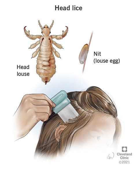 Delving into the Diverse Meanings of Lice Visions