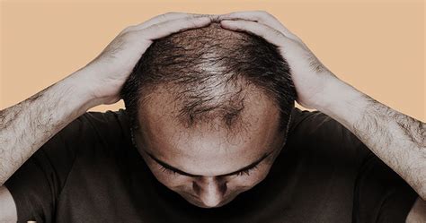 Delving into the Psychological Interpretation of Partially Bald Dreams