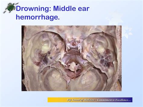 Disturbing Nightmare Phenomenon of Ear Hemorrhages