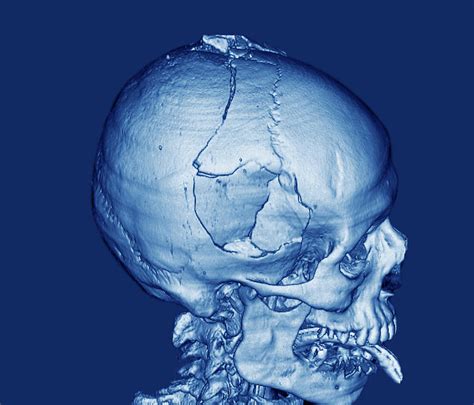 Dream Interpretation: Revealing the Mysteries of a Shattered Cranium