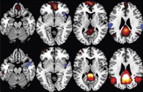 Dreaming as a Potential Indicator of Brain Activity in Individuals in Comatose State