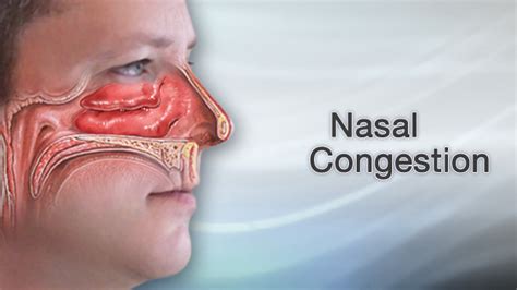 Dreaming of Relieving Nasal Congestion?