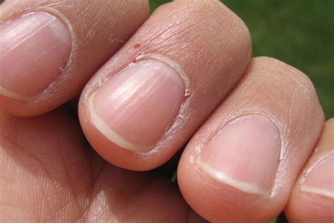 Dreams and Body Health: Investigating the Link between Absent Fingernails and Well-Being