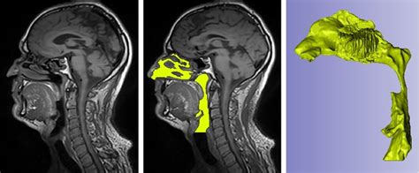 Dreams and Reality: Can Objects Truly Be Extracted from the Nasal Cavity?