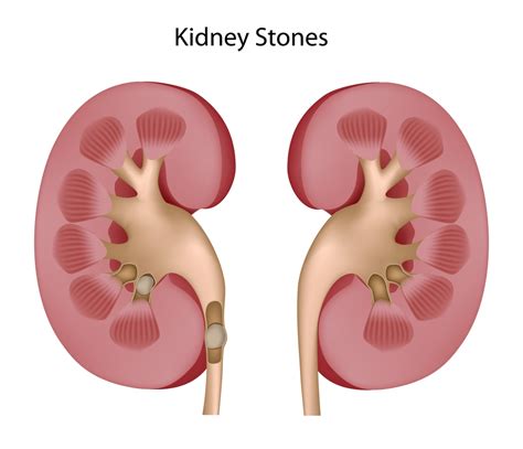 Dreams of Renal Stones: A concealed communication from your organism