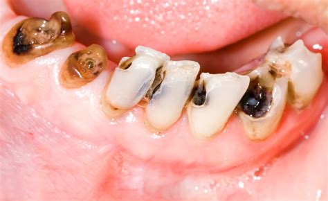 Dreams of Rotten Teeth: Uncovering Hidden Problems and Decay