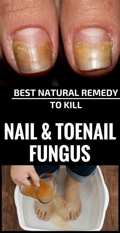 Effective Home Remedies for Treating Fungal Toenails