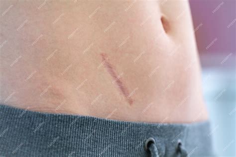 Emotional Scars Reflected Through Scratches on the Abdomen in Dreams