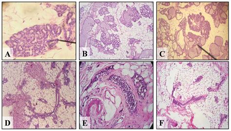 Empowerment or Loss: Analyzing the Impact of Dreaming about Removing a Mammary Gland