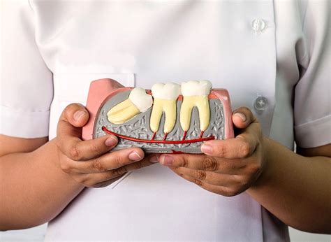 Exploring Alternative Approaches to Addressing Issues with Third Molars