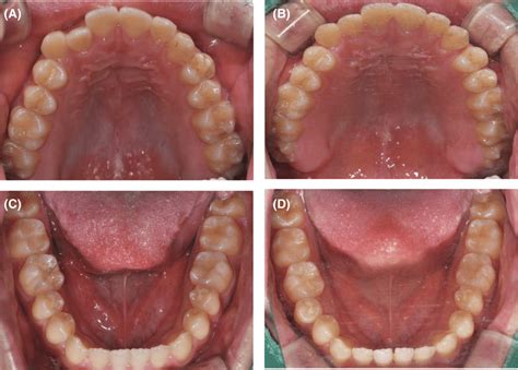 Exploring Common Symptoms and Indications of the Eruption of Third Molars