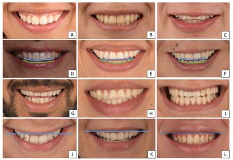 Exploring Diverse Perspectives on the Significance of Teeth Curvature in Dreams