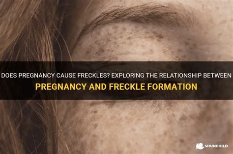 Exploring Freckles' Personal Life and Relationships