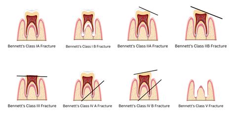 Exploring Gender Differences in Dreams About Dental Fractures: A Comparative Analysis