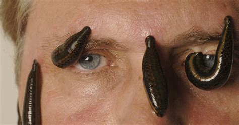 Exploring Possible Traumas Connected to the Presence of Leeches in Dreamscapes