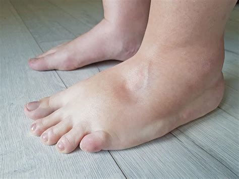 Exploring Potential Factors Behind Swelling in Foot-related Visions