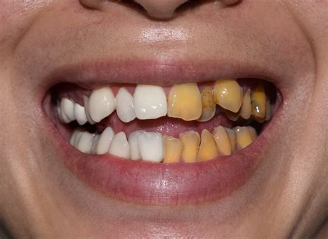 Exploring Potential Solutions for Nightmares of Decaying and Discolored Teeth