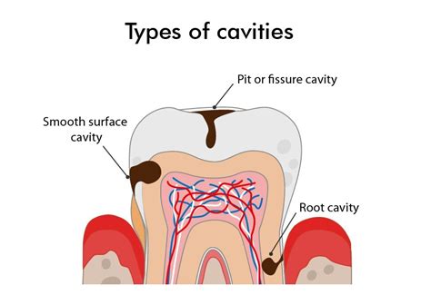 Exploring Various Categories of Cavities in Dreams and Their Explanations