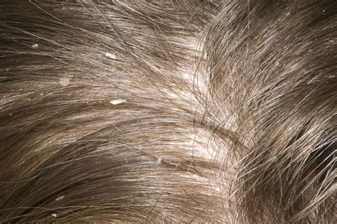 Exploring Various Medical Conditions: Dandruff, Psoriasis, and Lice