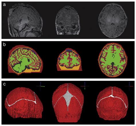 Exploring Ways to Analyze and Benefit from Dreams Featuring Sutures on the Forehead