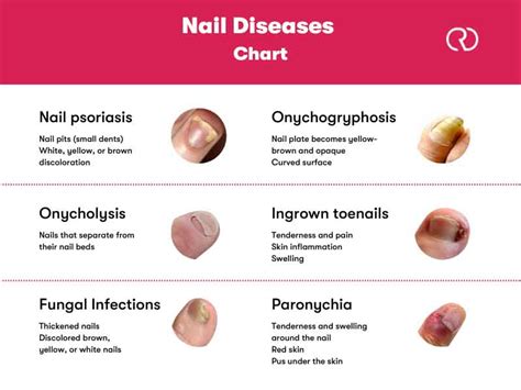 Exploring the Common Triggers for Dreams Involving Nail Loss