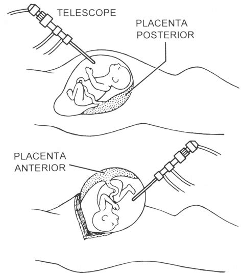 Exploring the Complexities of Prenatal Surgical Procedures