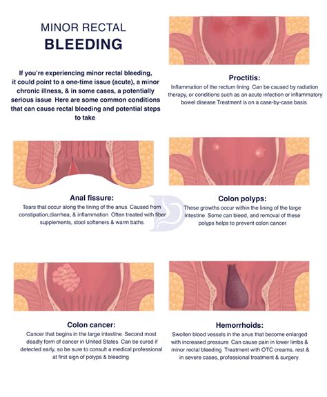 Exploring the Enigma of Dreams Involving Anal Bleeding