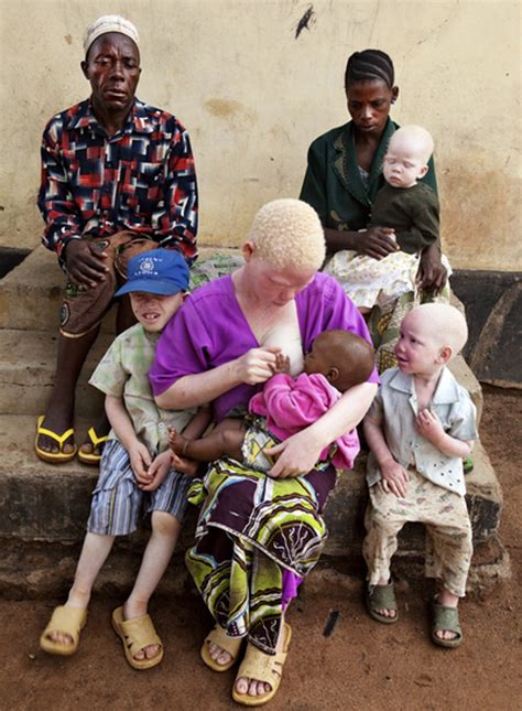 Exploring the Fascination Behind Parents' Desire for an Albino Offspring