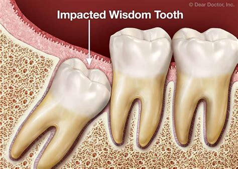 Exploring the Fascination with Extracting Wisdom Teeth: Essential Information to Unravel