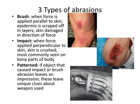 Exploring the Hidden Meanings in Touch Abrasions