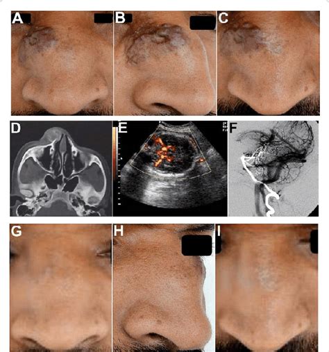 Exploring the Impact of Historical Beliefs on the Analysis of Nose Malformation Dreams