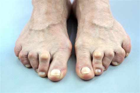 Exploring the Psychological Impact of Enlarged Toe Visions