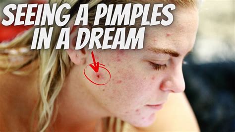 Exploring the Psychological Interpretations of Dreaming About Pimples