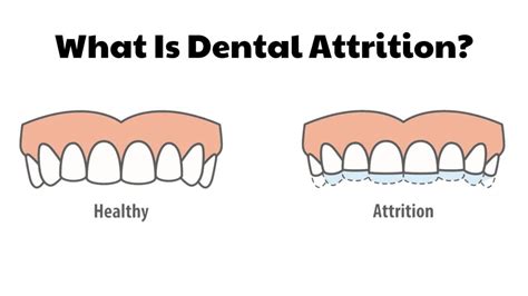 Exploring the Psychological Significance of Dental Attrition and Regeneration