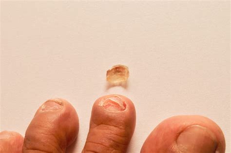 Exploring the Psychological Significance of Dreamed Nail Loss