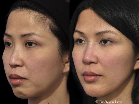 Exploring the Realm of Facial Enhancement: Journey into the World of Aesthetic Procedures