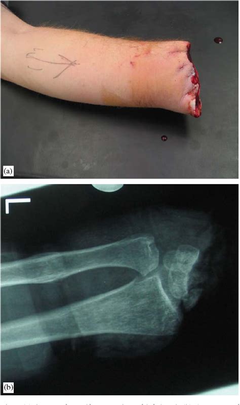 Exploring the Relationship between Body Integrity Identity Disorder and Fascination with Finger Amputation