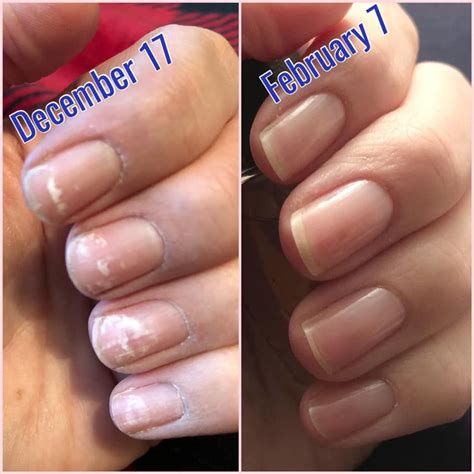 Exploring the Significance of Damaged Nail Extensions in Relation to Self-Image and Esteem