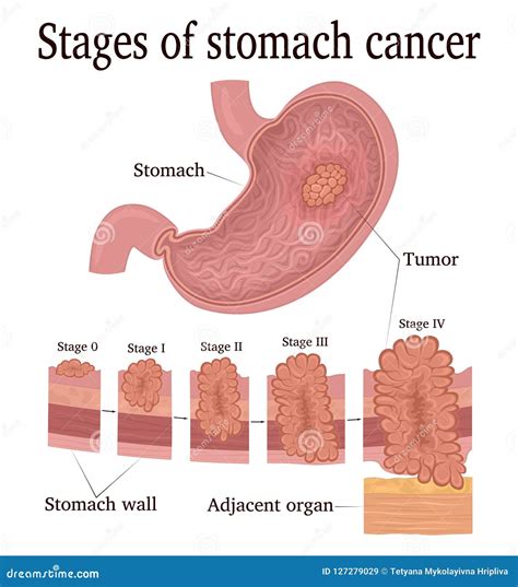 Exploring the Significance of Gastric Cancer Dreams in Personal Growth