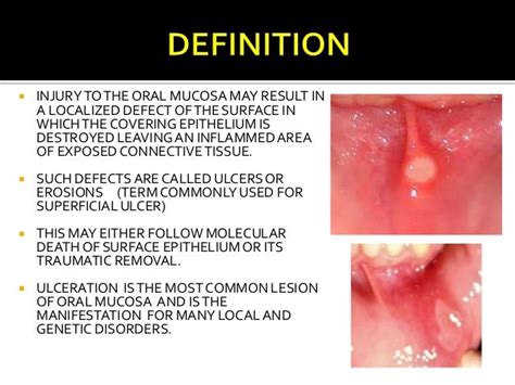 Exploring the Significance of Oral Lesions while Dreaming