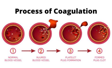 Exploring the Significance of Past Experiences in Dreams Involving the Expulsion of Blood Coagulations