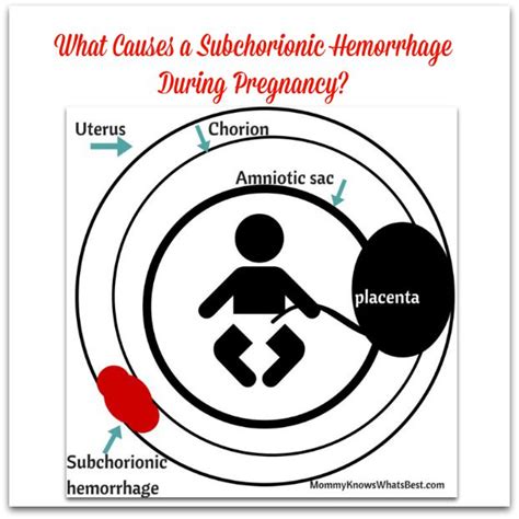 Exploring the Significance of Pregnancy-associated Haemorrhage in Dreamscapes