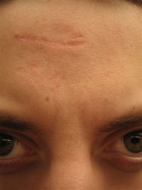 Exploring the Symbolism of Stitches on the Forehead