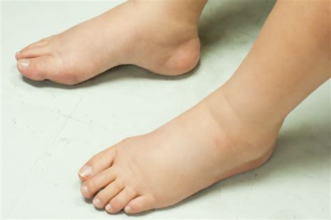 Exploring the Triggers of Swollen Toe Dreams