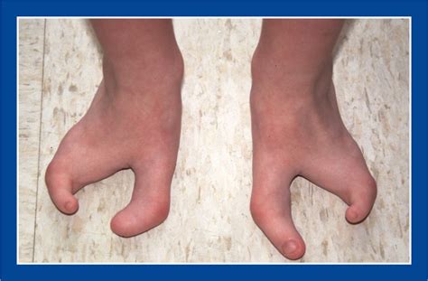 Exploring the Various Categories of Malformed Feet and Their Significance