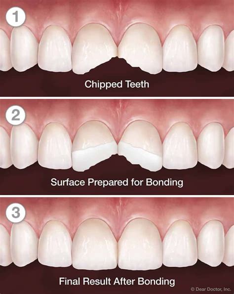 Exploring the advantages of dental bonding for a swift improvement