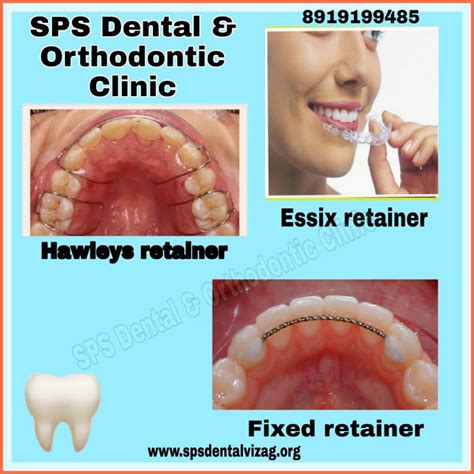 Final Steps: After Orthodontic Treatment and Retainers