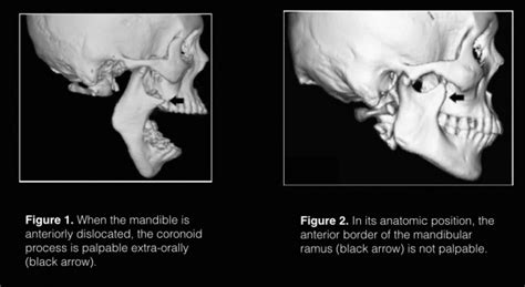 Genetic Factors: Can Jaw Dislocations Run in the Family?