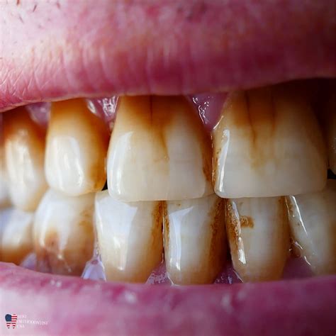 Glimpse Into Dental Health: Understanding the Possible Causes of Discolored Teeth in Dreams